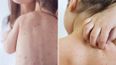 Warning to Irish parents following chickenpox outbreak