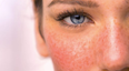 Rosacea awareness month: 3 skincare products many rosacea sufferers swear by