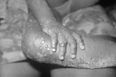 What exactly is monkeypox and is it dangerous?