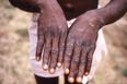 Parents told not to worry about monkeypox as cases are rare in children