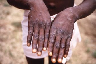Parents told not to worry about monkeypox as cases are rare in children