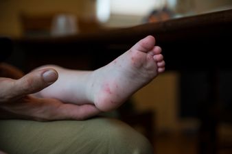 HSE urges parents to keep children with Hand, Foot and Mouth disease out of school