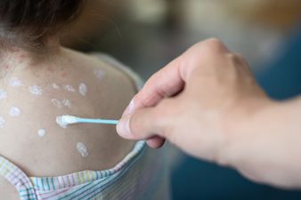 Mum reveals clever hack that stops chickenpox from itching