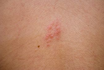 HSE issues shingles warning – here are the symptoms to look out for