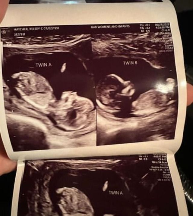 Mum with double uterus expecting 2 babies in '1 in a million' pregnancy