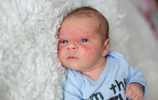 baby acne