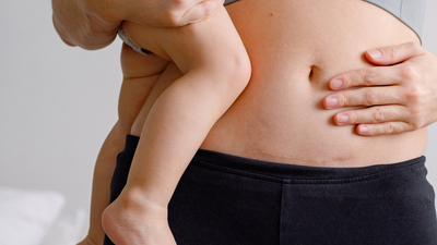 This is why you should pack gum in your hospital bag if you're having a c-section