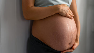 Can you prevent stretch marks in pregnancy?