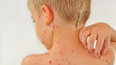 Parents urged to be ‘Chickenpox Aware’ following recent figures