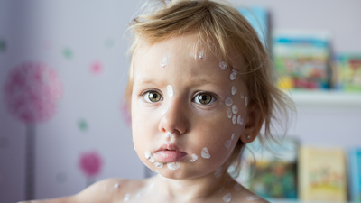 Babies will receive the chickenpox vaccine when they’re 12 months old
