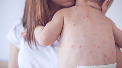 Warning issued after suspected case of measles at Dublin creche